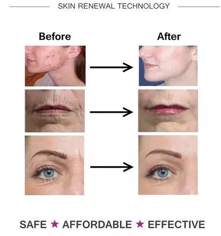 4-in-1 Derma Roller Therapy Kit